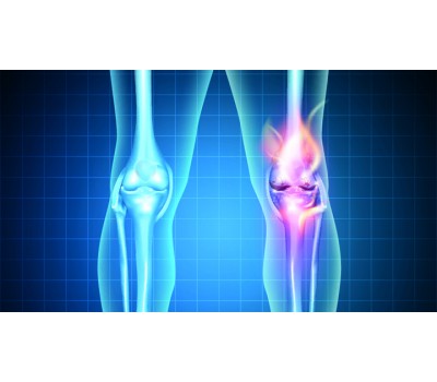 Gout & High Uric Acid